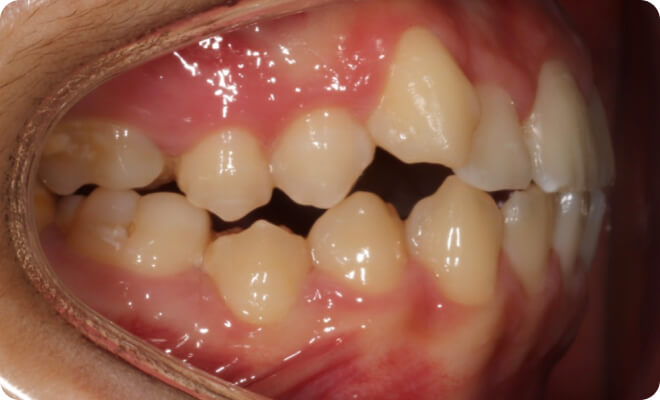 Cas cliniques réels sous le suivi de la plateforme orthodontique