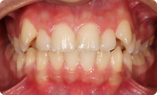 Cas cliniques concrets pris en charge par le suivi numérique Orthosafe