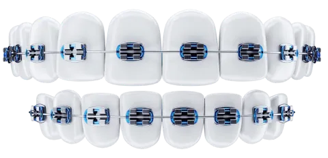 white teeth with metal braces blue background dental braces orthodontic treatment dentistry teeth whitening protection oral care hygiene healthcare 3d illustration 3d render 1 Accueil Orthosafe